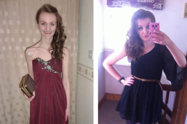 Positive Before and After Pics of Eating Disorder Sufferers