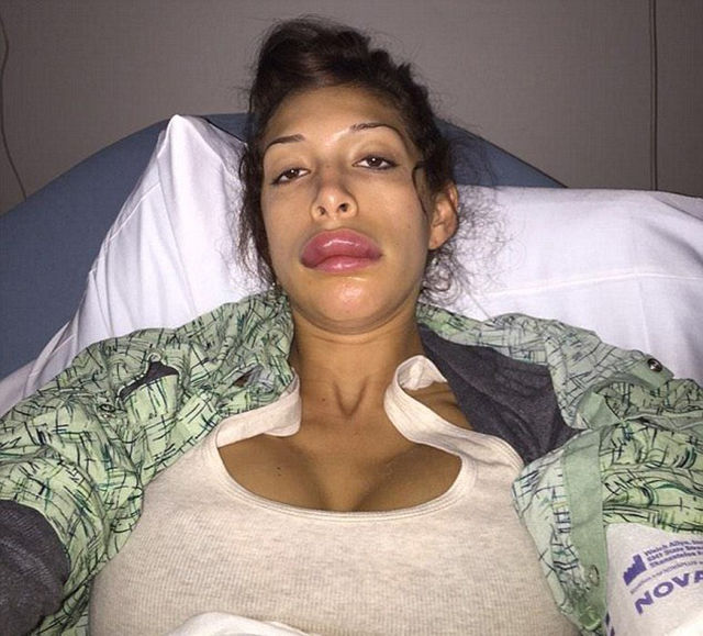 Teen Mom’s Dramatic Lip Enhancement Fail