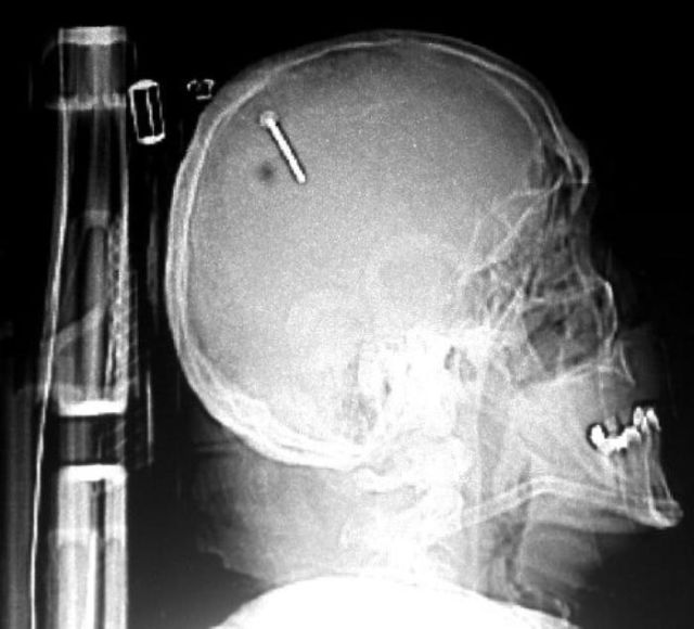 The Most Bizarre Items That Have Gotten Stuck in People’s Bodies