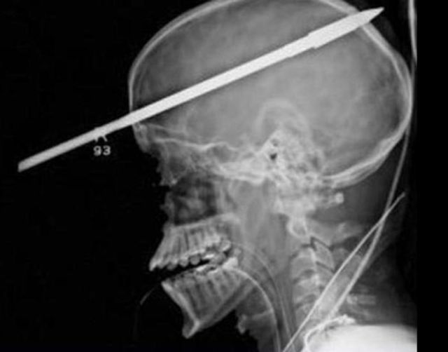 The Most Bizarre Items That Have Gotten Stuck in People’s Bodies