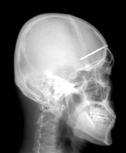 The Most Bizarre Items That Have Gotten Stuck in People’s Bodies