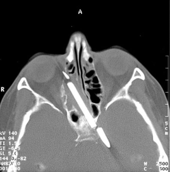 The Most Bizarre Items That Have Gotten Stuck in People’s Bodies