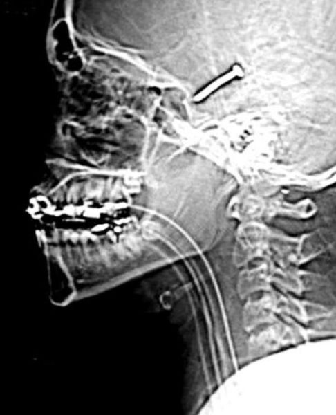 The Most Bizarre Items That Have Gotten Stuck in People’s Bodies