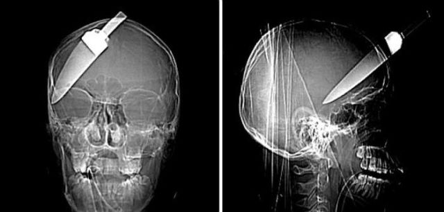 The Most Bizarre Items That Have Gotten Stuck in People’s Bodies